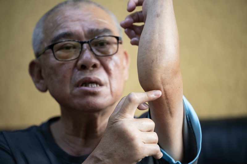 沙利窦迈药害者步入老年 60年无人研究就医成难题 1 沙利竇邁藥害者林烝助曾在工地摔跤、跌斷手,開刀留下疤痕。檢查時醫師才發現原本該有尺骨與橈骨的前臂,他卻只有一根骨頭。(攝影/楊子磊)