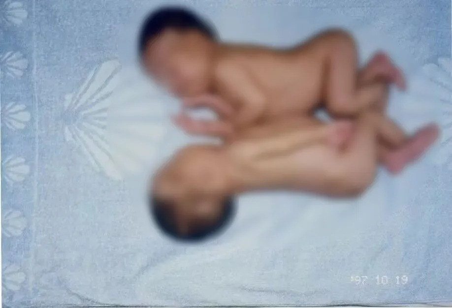 28年前，女嬰的媽媽曾在這裏作為連體嬰兒接受分離手術。28年後，女嬰又在通大附院順利出生，恰好串聯起這段跨越近30年的生命接力。（人民日報）