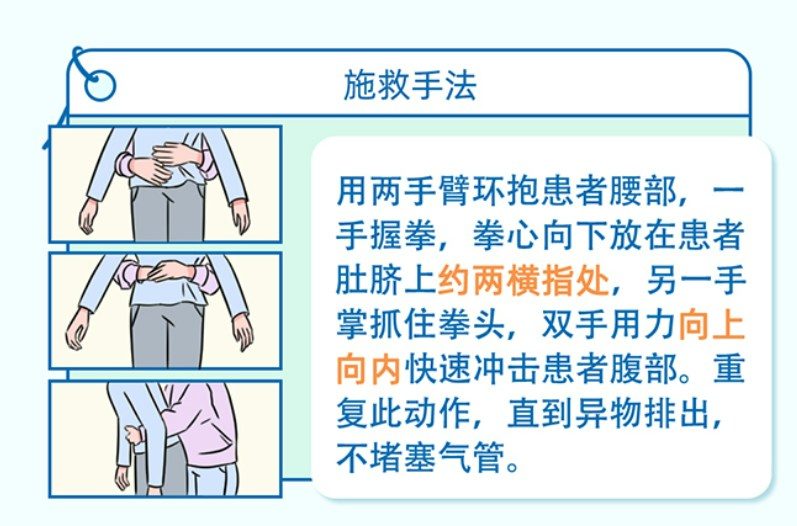 海姆立克急救法示意圖。（深圳市衛生健康委員會）