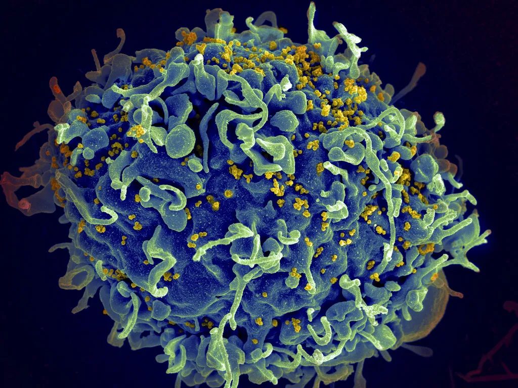 電子顯微鏡底下的人類T細胞（藍色部分）正遭到人類免疫缺乏病毒（HIV，黃色部份）攻擊。（美聯社）