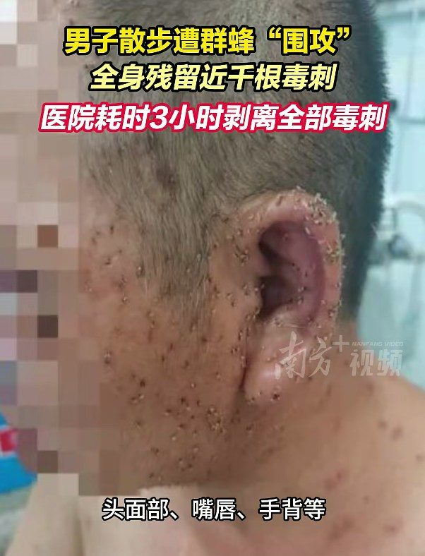 入秋注意!男子散步遭蜂群围攻 全身千根毒刺 医生拔刺近3小时 1 患者頭面部、嘴唇、手背等佈滿密密麻麻的黑色毒刺,粗略估計近千根。(南方新聞網)