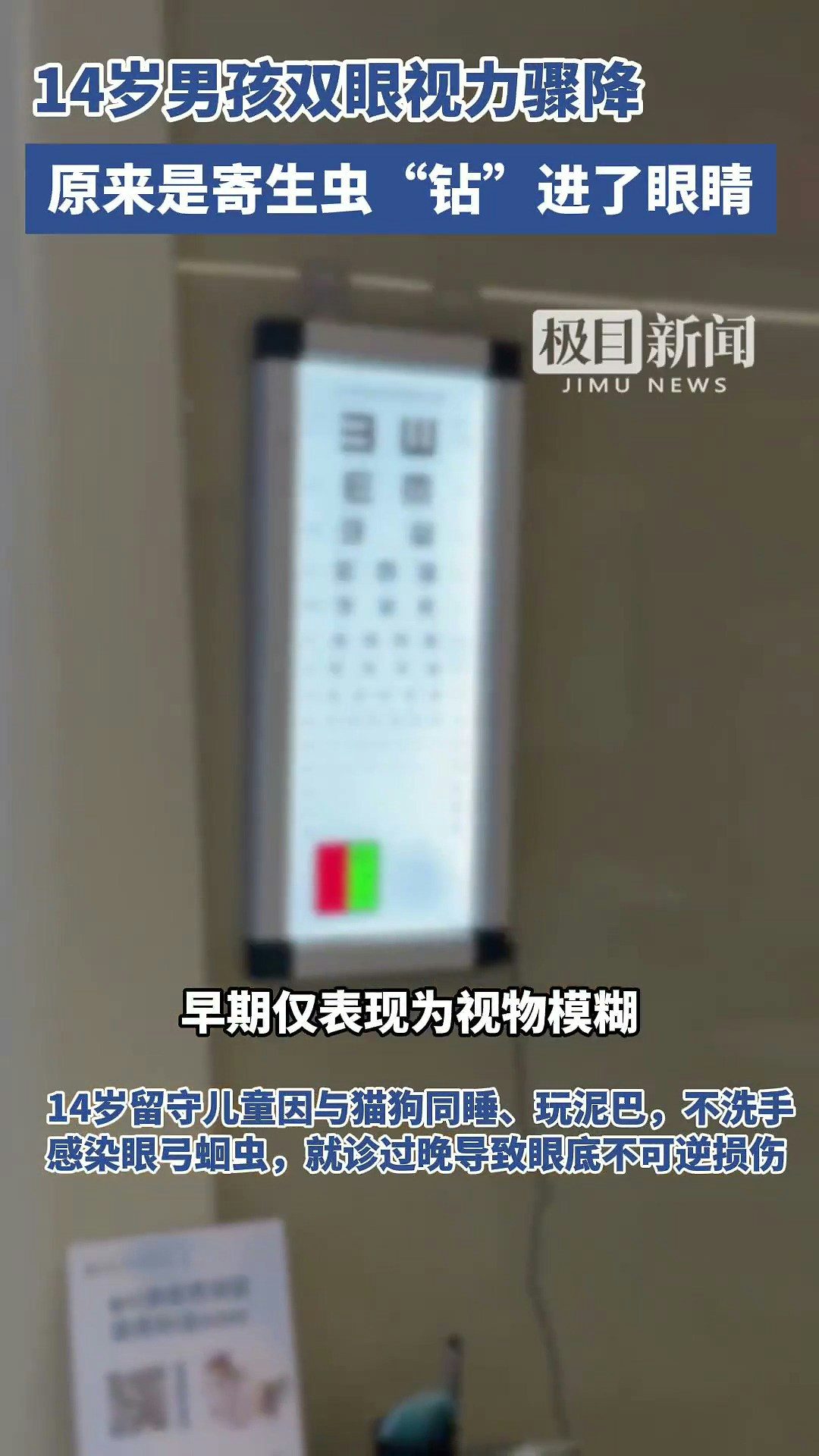 14歲的湖北京山男孩小宇（化名），雙眼視力已降至右眼0.02.左眼0.1，近乎失明。經檢查，他被確診為眼弓蛔蟲感染，眼底已造成不可逆損傷，險些徹底失明。據了解，小宇常與家中的土貓土狗同吃同睡。（截取自微博@極目新聞）