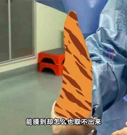 浙江男将「空可乐瓶」套下体卡死肿到发紫 医:超12小时恐需切除 9 深圳一名中年男子,因假陽具卡在體內導致腸穿孔。(微博@第一現場)