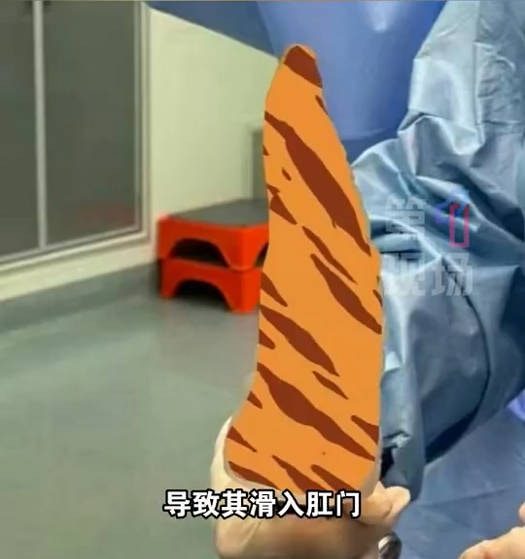 浙江男将「空可乐瓶」套下体卡死肿到发紫 医:超12小时恐需切除 8 深圳一名中年男子,因假陽具卡在體內導致腸穿孔。(微博@第一現場)