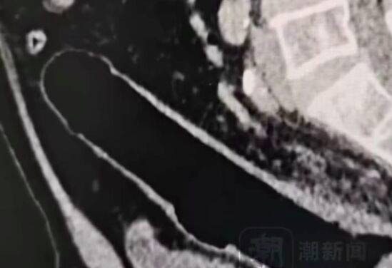 浙江男将「空可乐瓶」套下体卡死肿到发紫 医:超12小时恐需切除 4 根據內媒報導,該男子在事發當下曾就醫,尷尬表示自己不小心坐到假陽具,導致其滑入肛門,雖然能摸得到,但卻無法將異物取出。(微博圖片)