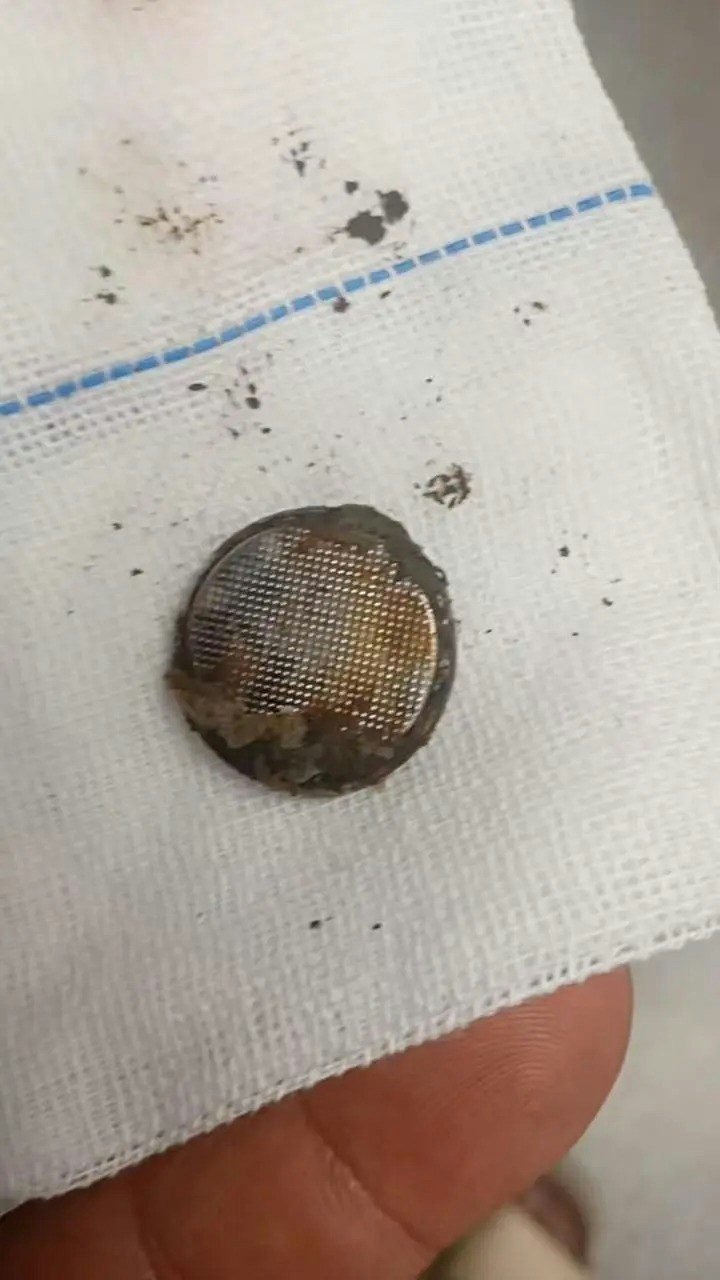 醫生通過全麻胃鏡急診手術取出了孩子食道中的圓形物體，家人這才知道孩子吞下了紐扣電池（button cell battery）。取出的紐扣電池表面已發黑、鏽蝕，邊緣帶有組織液乾涸的痕跡，而電池所在的食道位置已發生嚴重腐爛和灼傷。（《粵TV》）