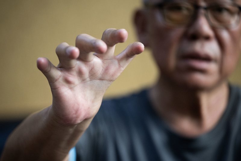 沙利窦迈药害60年 台湾3位「沙儿」的生命故事 4 雖然五指俱全,但拇指長成另一隻食指,五指同一方向──許多藥害者都缺少橈骨,也就不會有大拇指,這讓手部功能大減。(攝影/楊子磊)