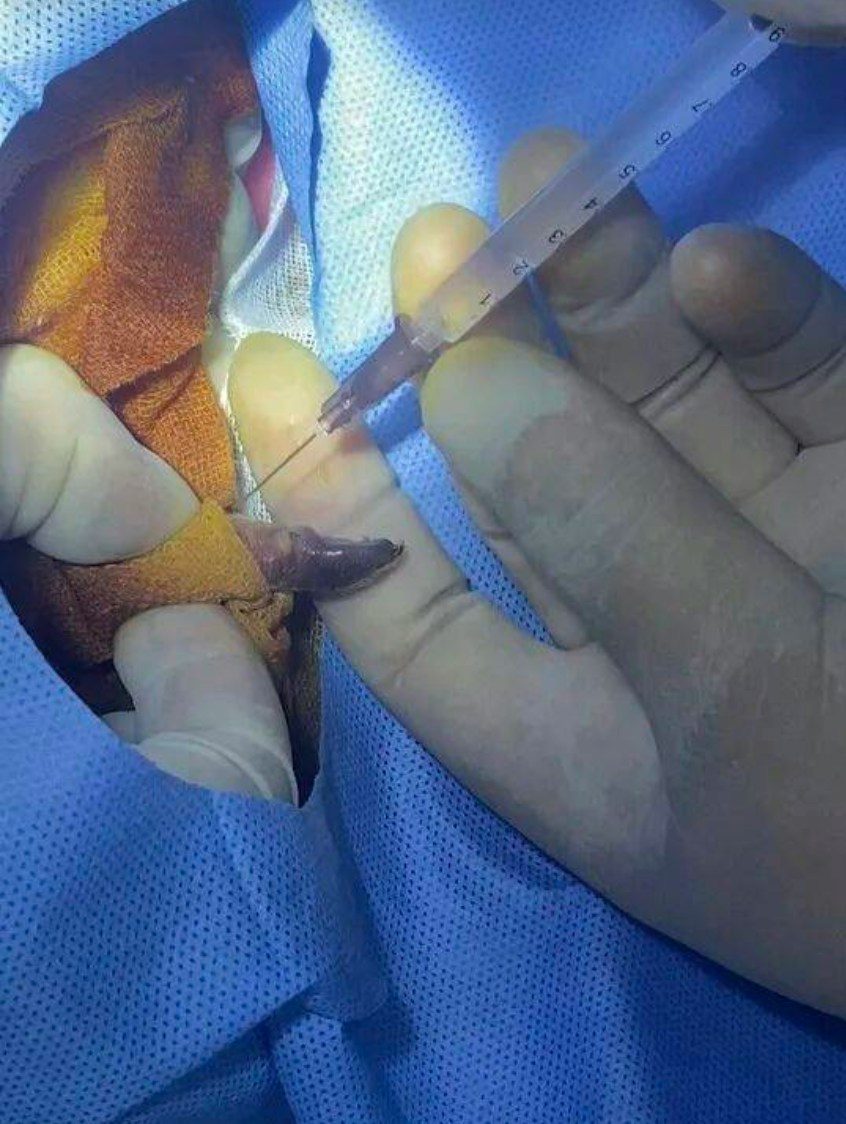 全球首例!成都歪脸大熊猫北侠「箍牙」 半年恢复健康不再漏奶 4 手術在2023年初進行,從晚上9時持續到凌晨1時。