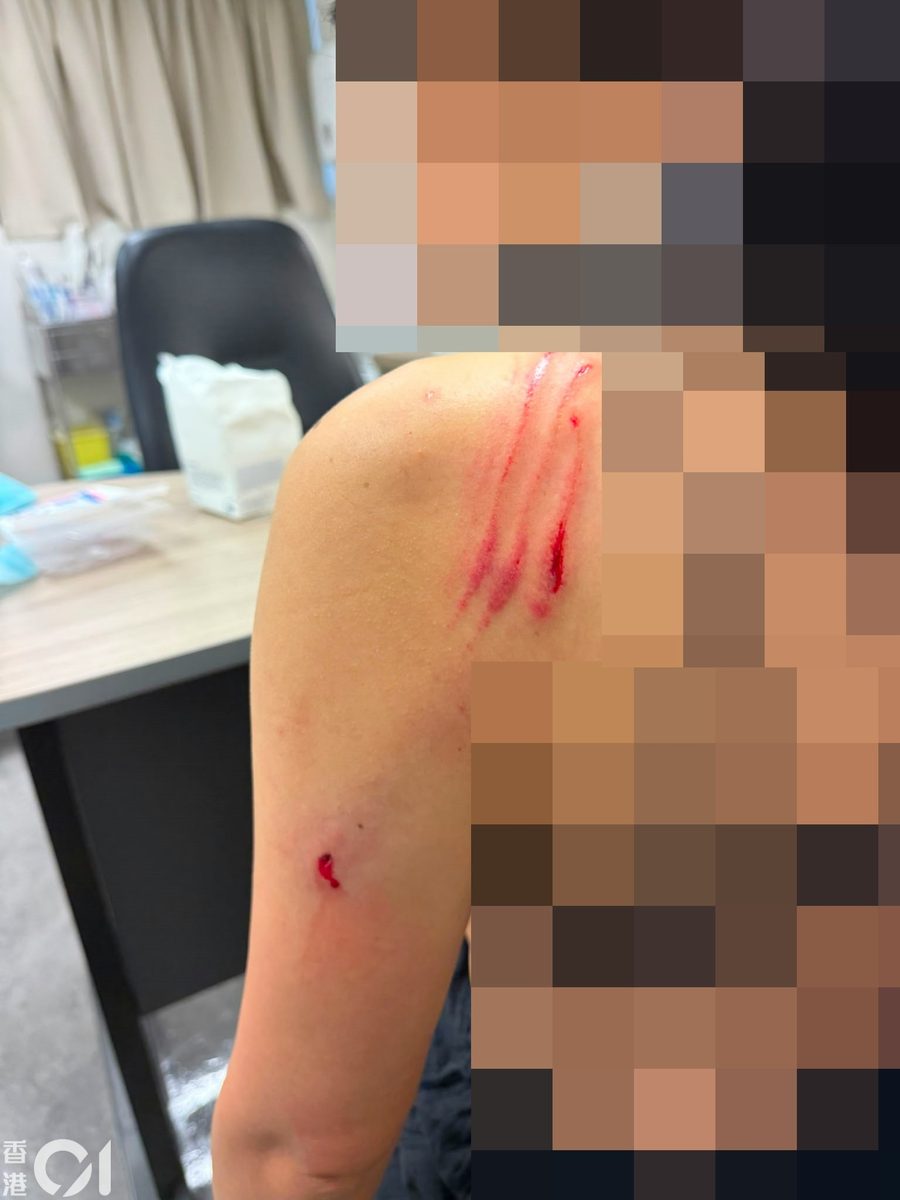 港岛渣甸山女途人疑遭大狗扑上身 又咬又抓肩背浴血 渔护署跟进 1 女傷者左邊肩背可見有幾道抓痕,手臂亦有傷口,事後流着鮮血。(讀者圖片)