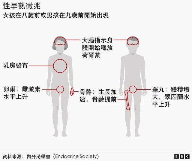 性早熟:我六岁就来月经了,但医生们也不知道为什么 5 一张男女身体的插图标示了儿童性早熟的征兆。