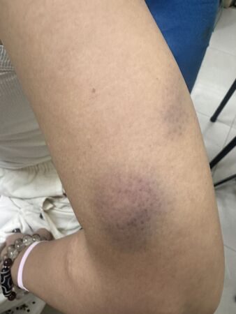 獨家 /八點檔女星遭家暴痛毆傷勢曝光！多處挫傷瘀青、耳內出血左手抬不起　忍痛單手駕車返北