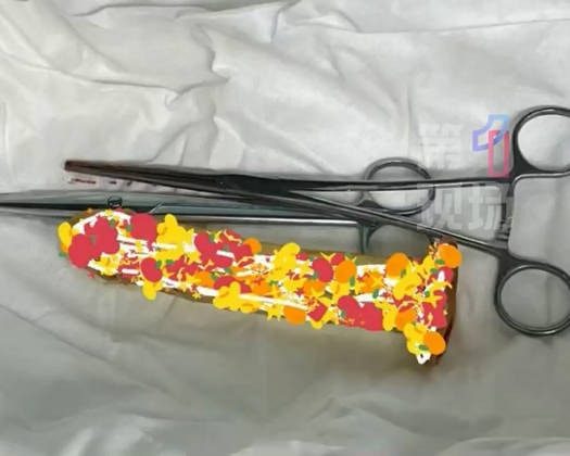 浙江男将「空可乐瓶」套下体卡死肿到发紫 医:超12小时恐需切除 3 【延伸閲讀:深圳中年男肛門「不小心坐到」假陽具 死忍3日劇痛腸穿窿需做手術】深圳一名中年男子,因假陽具卡在體內導致腸穿孔。(微博@第一現場)