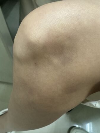 獨家 /八點檔女星遭家暴痛毆傷勢曝光！多處挫傷瘀青、耳內出血左手抬不起　忍痛單手駕車返北