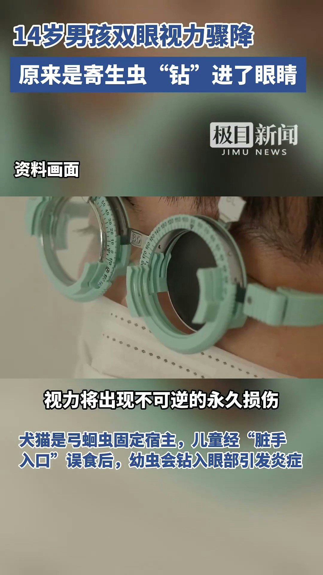 14歲的湖北京山男孩小宇（化名），雙眼視力已降至右眼0.02.左眼0.1，近乎失明。經檢查，他被確診為眼弓蛔蟲感染，眼底已造成不可逆損傷，險些徹底失明。據了解，小宇常與家中的土貓土狗同吃同睡。（截取自微博@極目新聞）