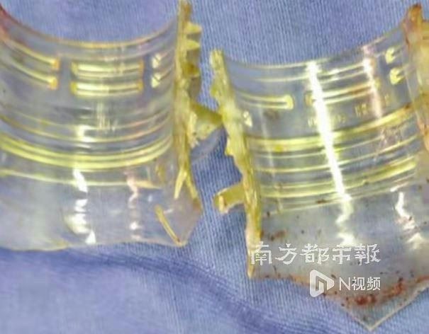 浙江男将「空可乐瓶」套下体卡死肿到发紫 医:超12小时恐需切除 2 被拆下來的可樂瓶口。(微信視頻號@南方都市報)