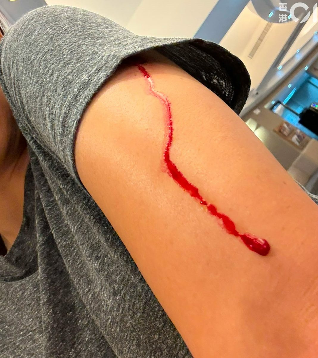 港岛渣甸山女途人疑遭大狗扑上身 又咬又抓肩背浴血 渔护署跟进 3 女傷者左邊肩背受傷,事後流着鮮血。(讀者圖片)