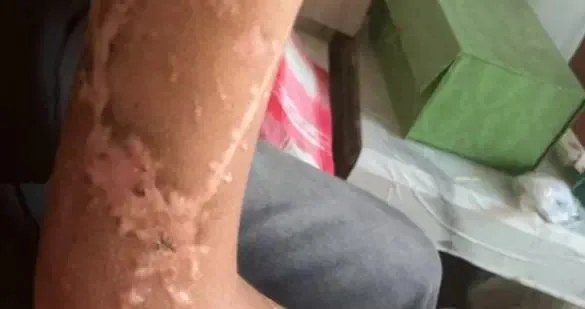 来源报道所附的受伤手臂照片。